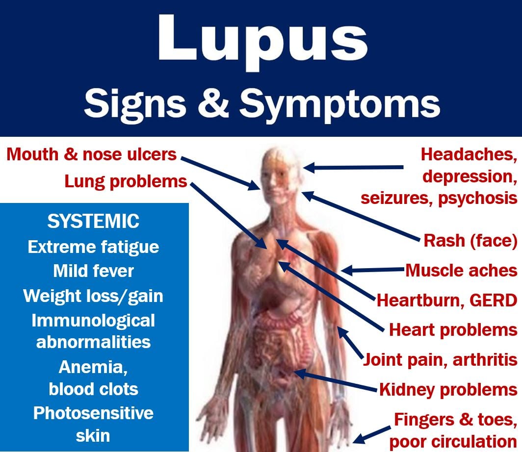 What Labs Are Drawn For Lupus