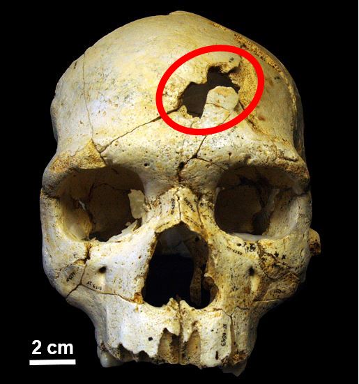 Evidence of ancient murder on skull