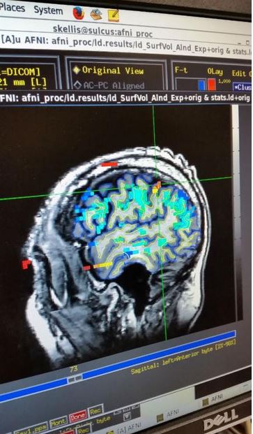 fMRI scan