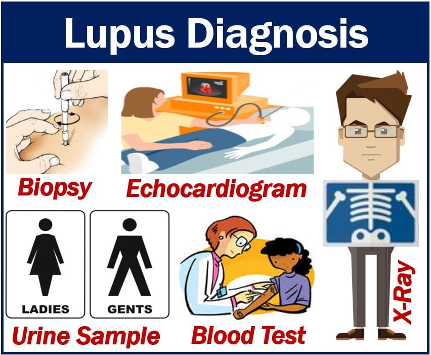 Lupus diagnosis and different types of tests doctors order - MBN Health