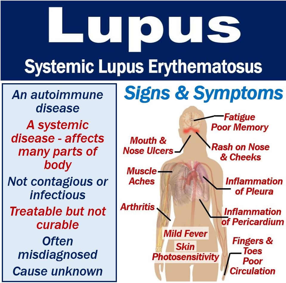 lupus headaches