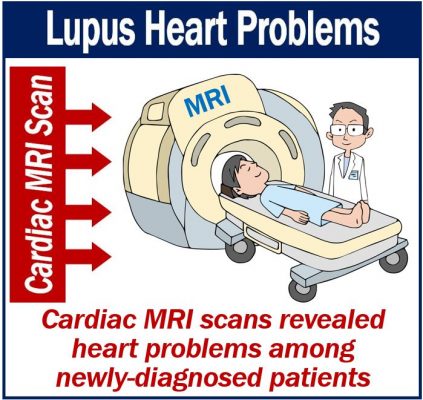 Heart problems among lupus patients - cardiac MRI