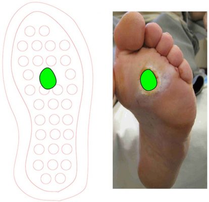 Customizing insole to treat specific diabetic ulcers