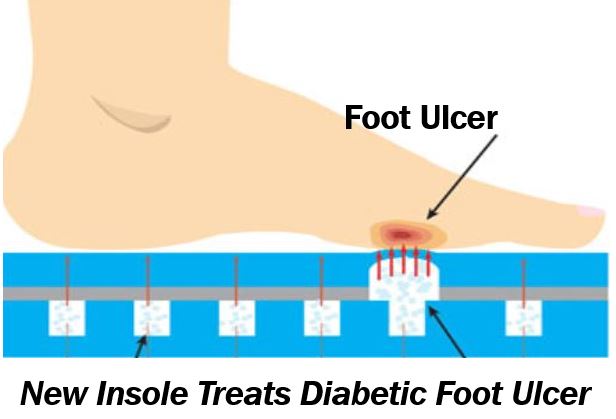 Insole treats diabetic foot ulcers thumbnail