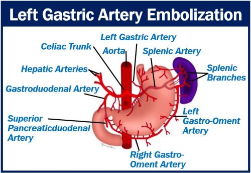 Left Gastric Artery Embolization