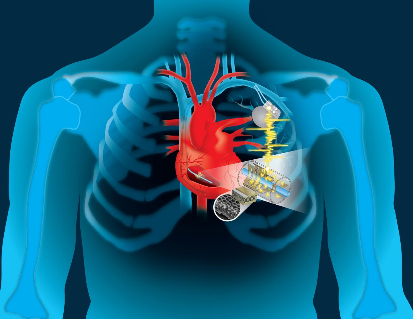 human_heart_implantable_devices