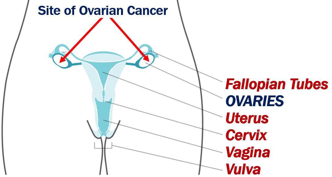 Ovarian cancer and AI article - image 1