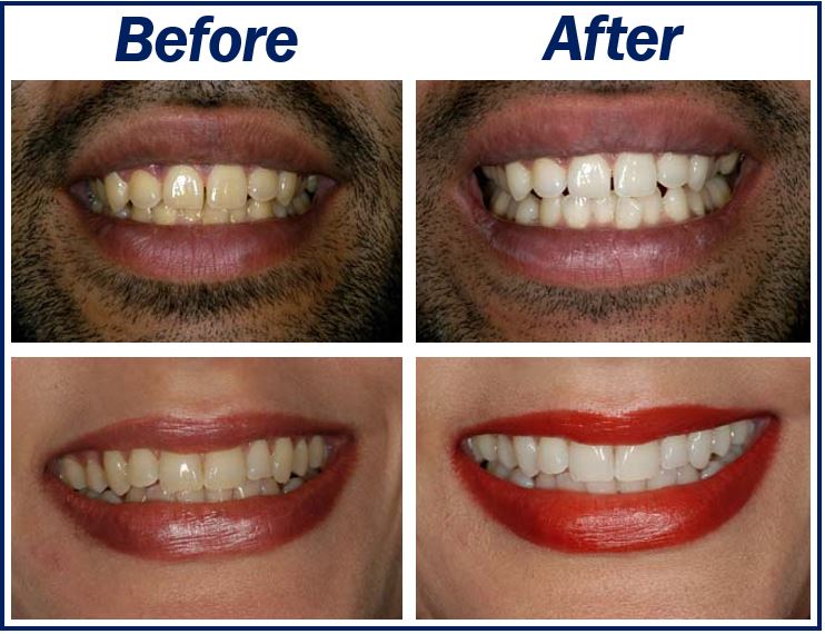 Stained Teeth Image 3323333