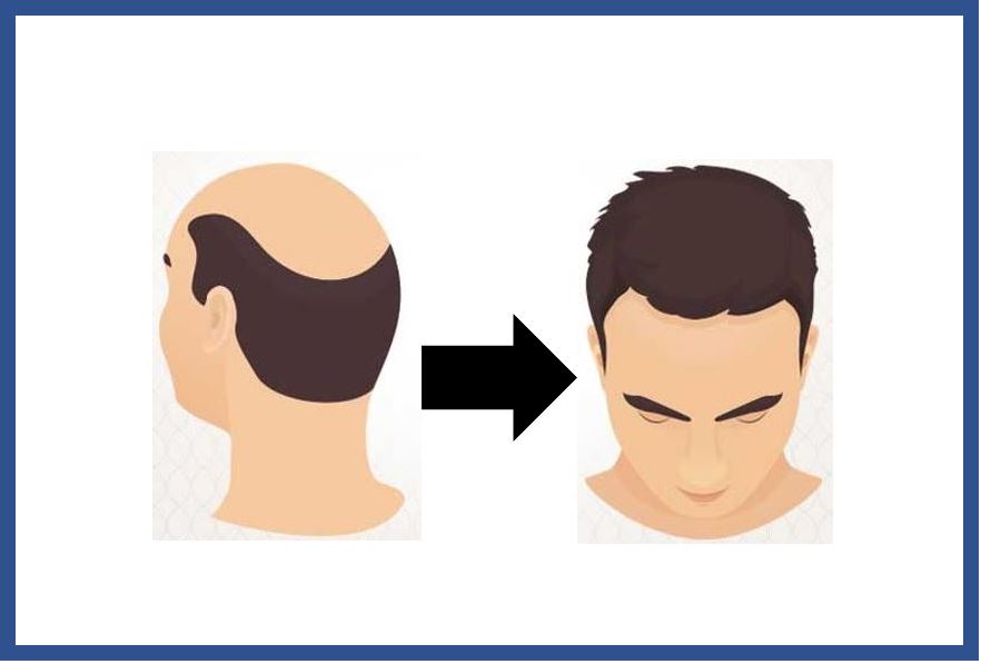 Sapphire Hair Clinic: High-Quality Hair Transplant in Istanbul