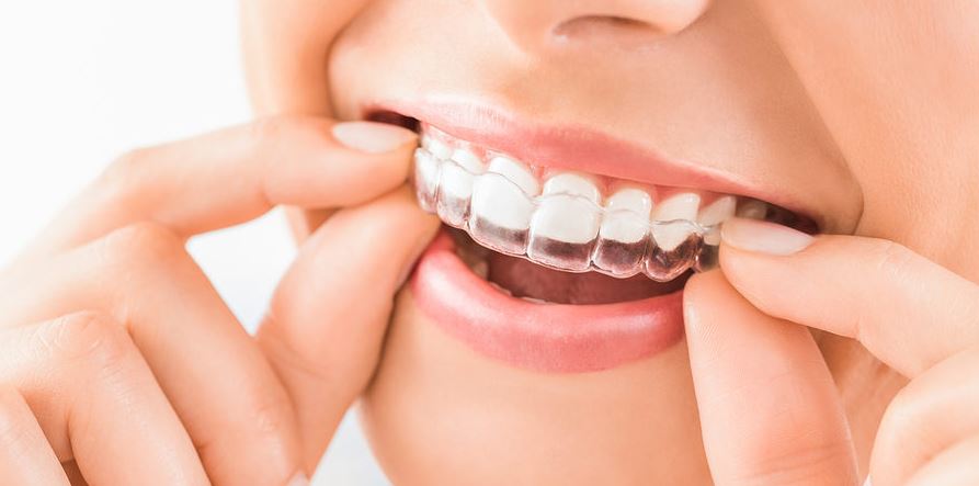 Invisible aligners for straightening teeth
