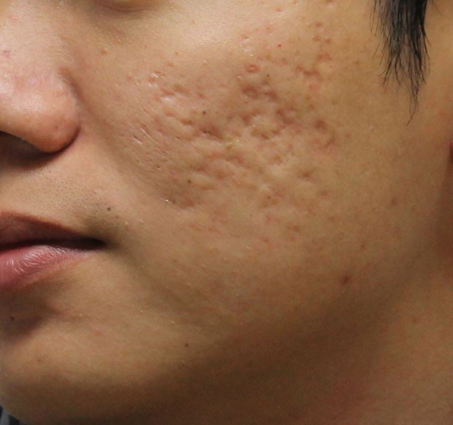 Acne scarring image 39939993