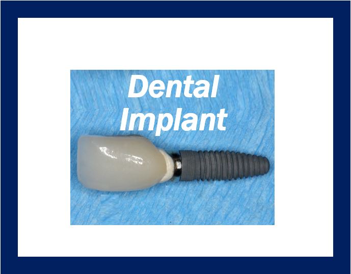 Dental implants thumbnail image 49494949