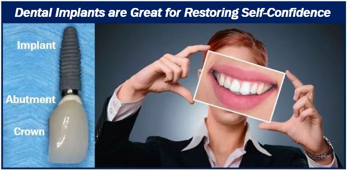 Dental implants image 44444