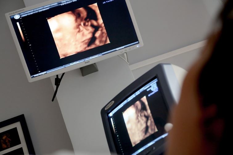 4D ultrasound scan image 4544444