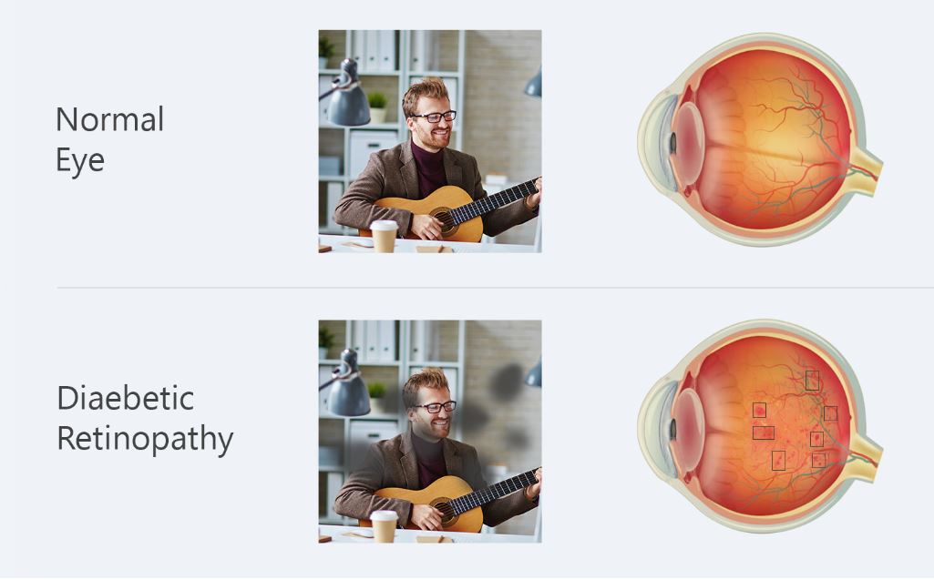 Diabetic retinopathy eye diseases image