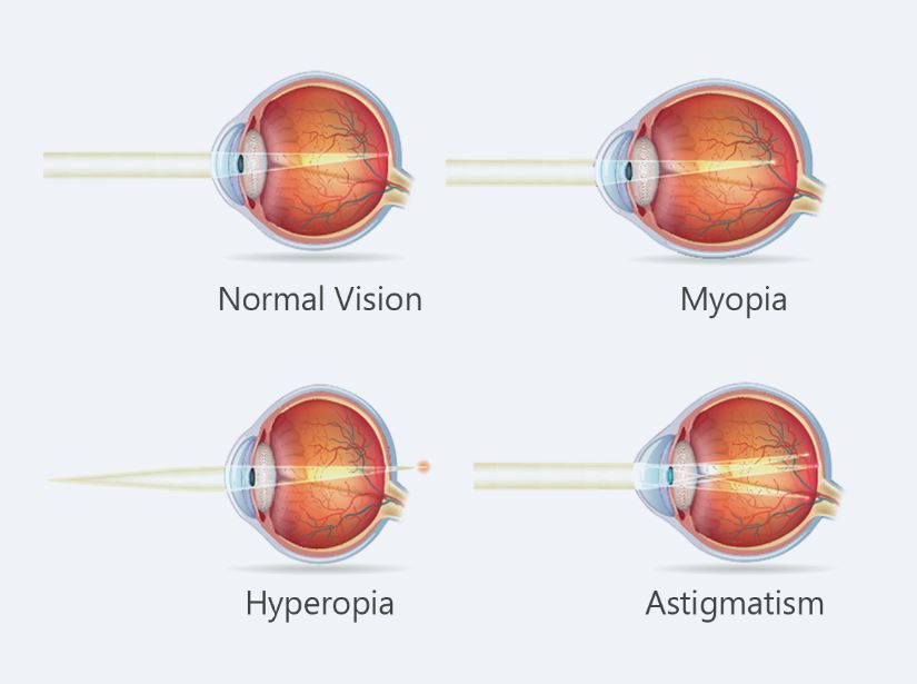 Errors in the eye eye 34333