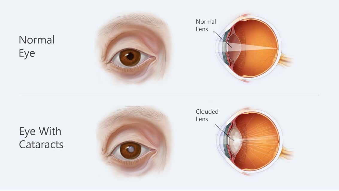 Eye diseases cataracts image