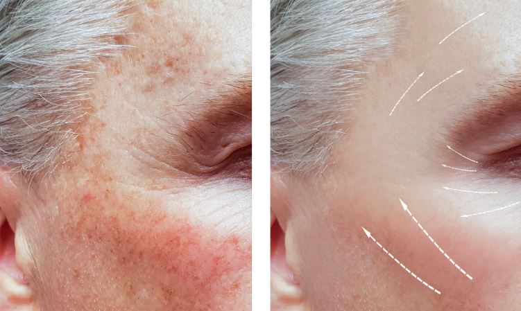 Laser pigmentation removal image 2 399399j9