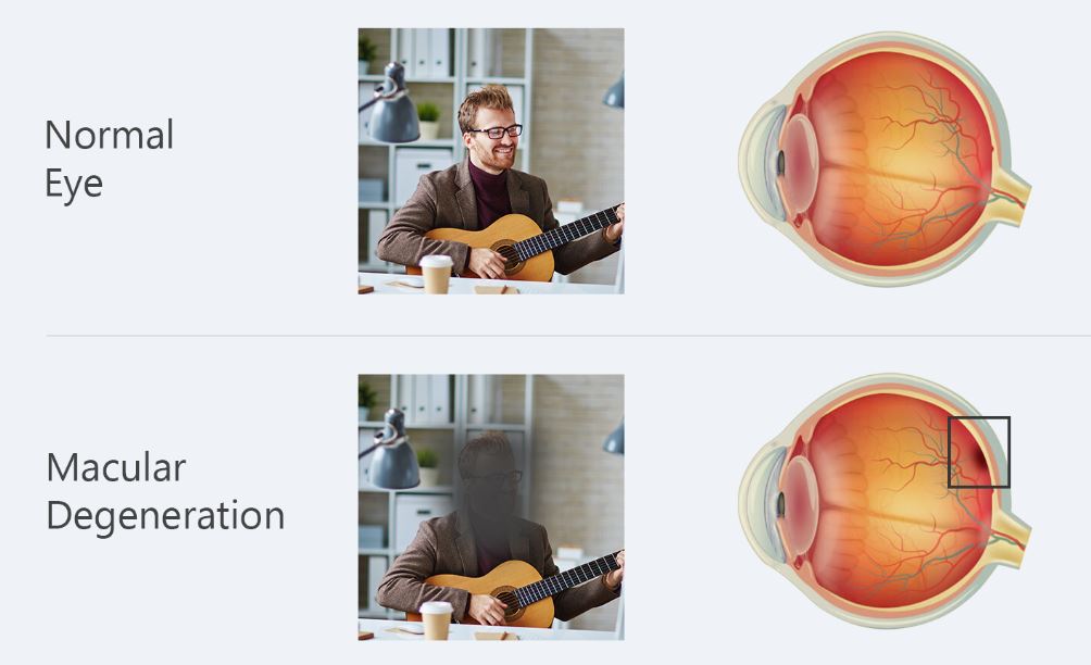 Macular degeneration eye diseases image