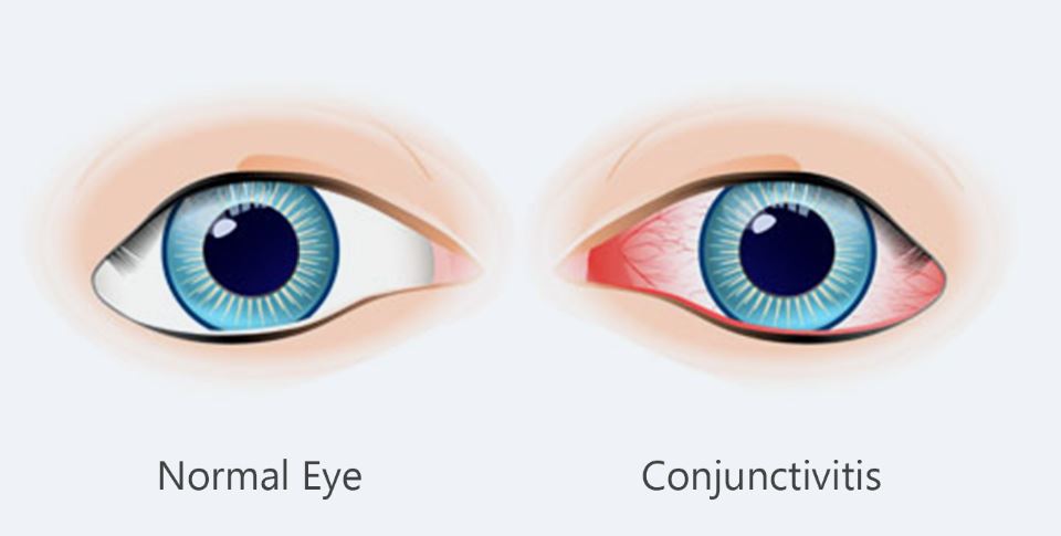 conjunctivitis