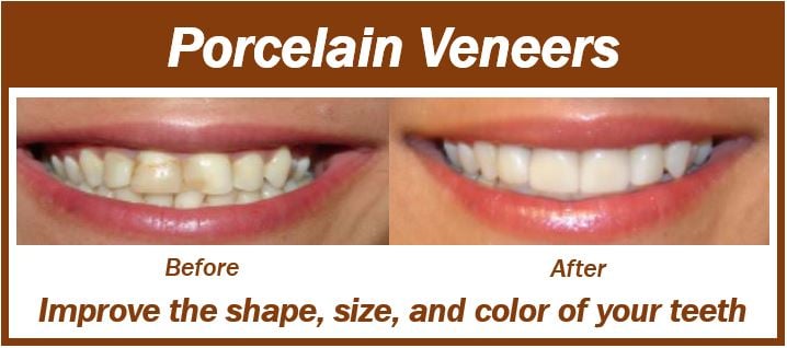 Before and after smiles - dental veneers