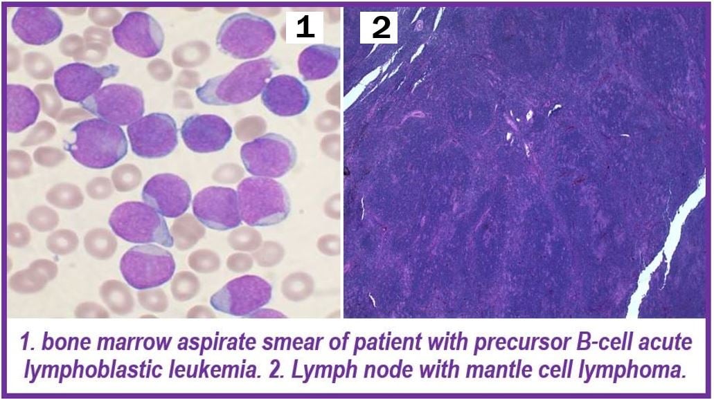 Leukemia and lymphoma - image for article - 49837587667