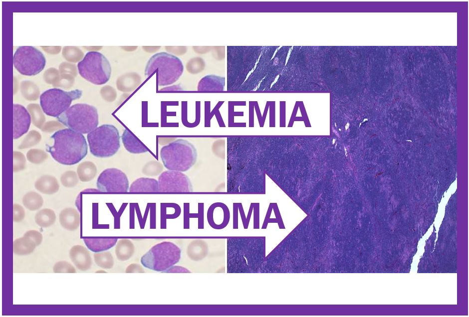 Leukemia and lymphoma - thumbnail image