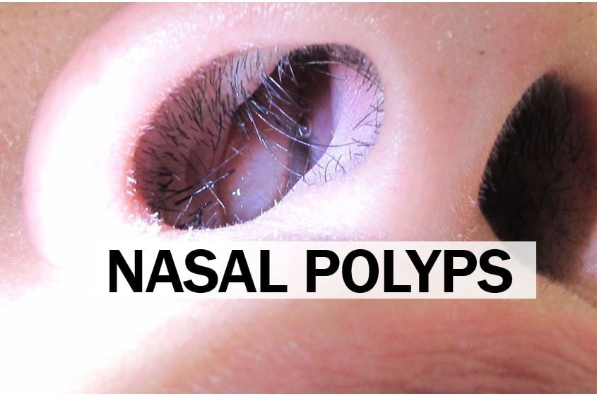 The Biology and Management of Nasal Polyps - Market Business News