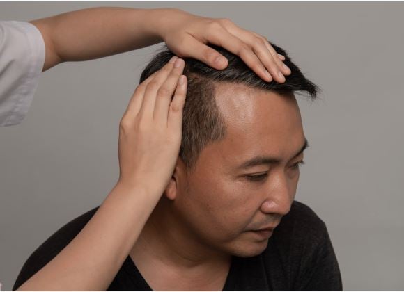 Causes of Hair Loss  How to Stop Hair Loss for Men