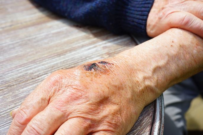 Personal Injury on Elders - image for article 4993