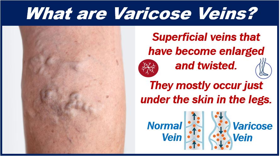 What are varicose veins - image 499399288