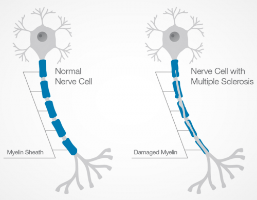 What You Must Know About Multiple Sclerosis Stem Cell Research