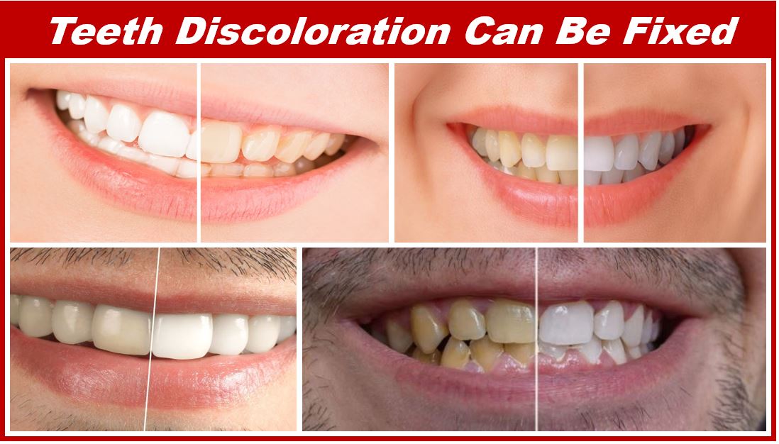 Teeth discoloration can be fixed - stained teeth before and after - 493939