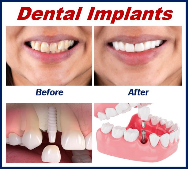 Dental Implants - article about cosmetic dentistry 34bb3