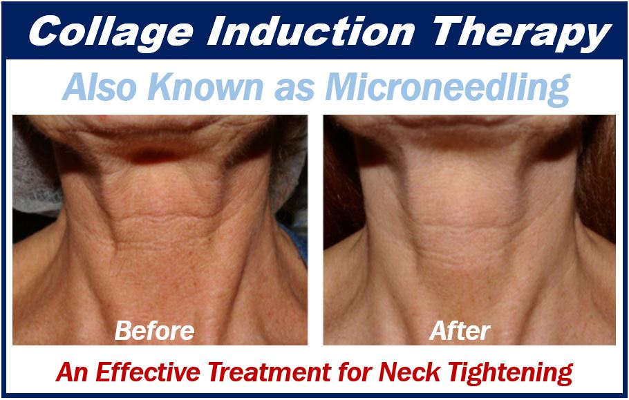 Top benefits of microneedling - 29dfdfdfdf939