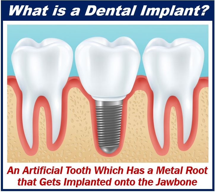 Dental Implant - Treatments and Trends in Cosmetic Dentistry