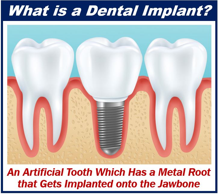 Dental Implant - Treatments and Trends in Cosmetic Dentistry