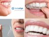 Top 5 Tips After Invisalign Treatment