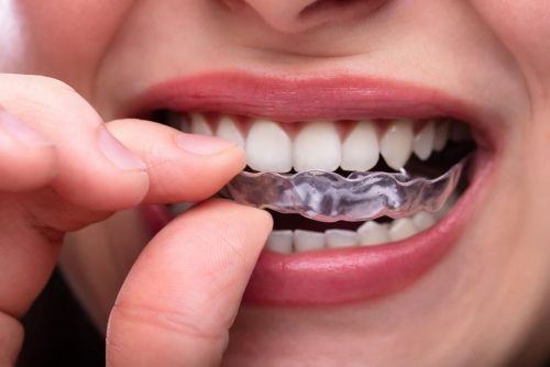 Follow These Steps To Ensure Effective Invisalign Treatment - 32