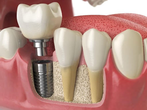 A Comprehensive Guide to Choosing the Best Dental Implants