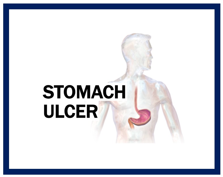 Stomach Ulcer - Thumbnail