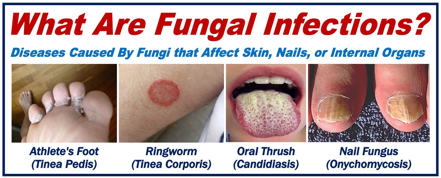 4 photos showing athlete's foot, ringworm, oral thrush, and nail fungus. Article about fungal infections