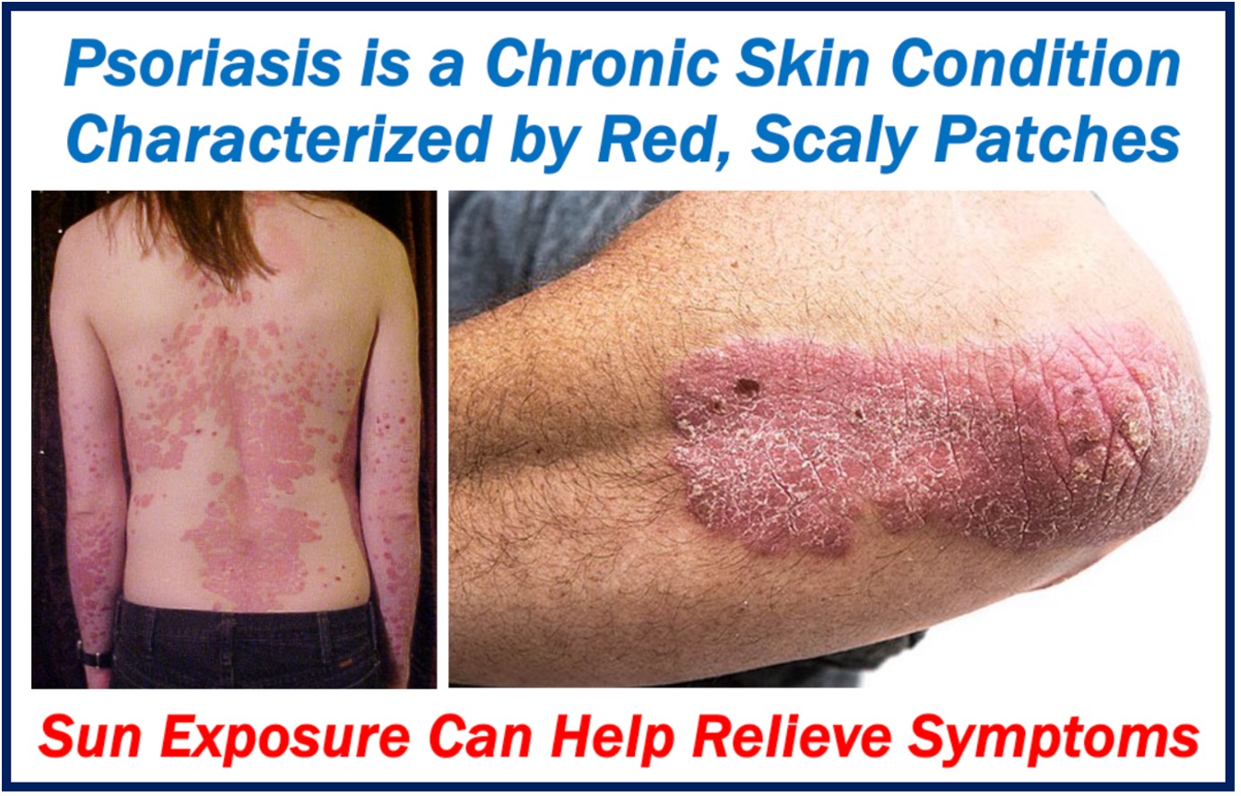 Two images of patients with psoriasis.